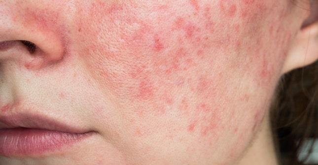 Brimonidine 0.33% Gel (Erythego): Targeted Relief for Rosacea Redness Brimonidine